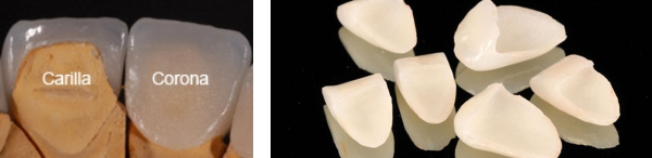 imagen carillas de porcelana